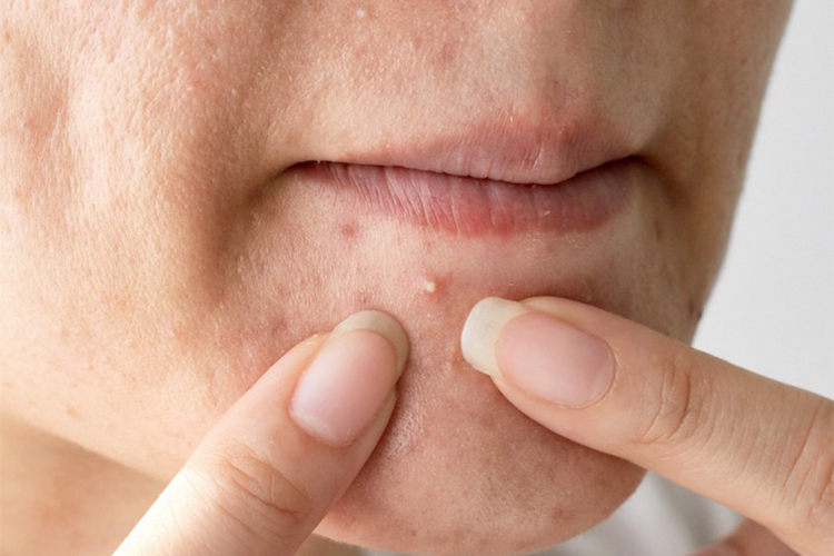 Effects of white heads on face
