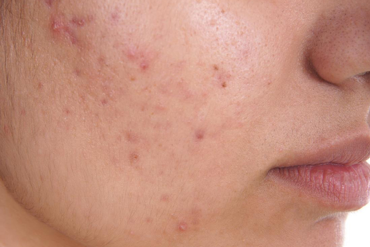 Effects of white heads on face