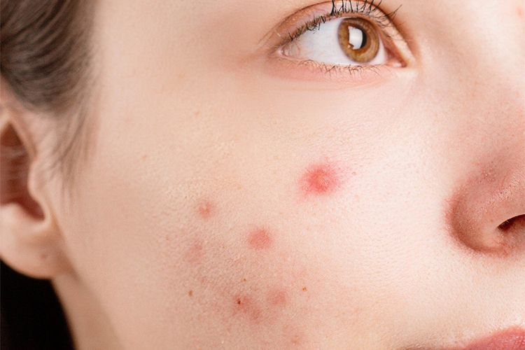 Effects of white heads on face