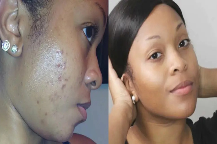 How to get rid of dark spots on face